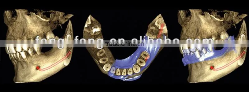 Digital 3D Intra-oral imaging X-ray machine