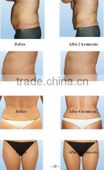 Professional 2014 Quick fat burn Ce approval hot selling EXW lowest home use cav+rf machine