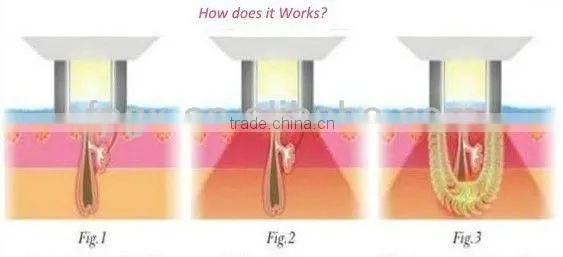 Alibaba china hot sale laser hair removal training