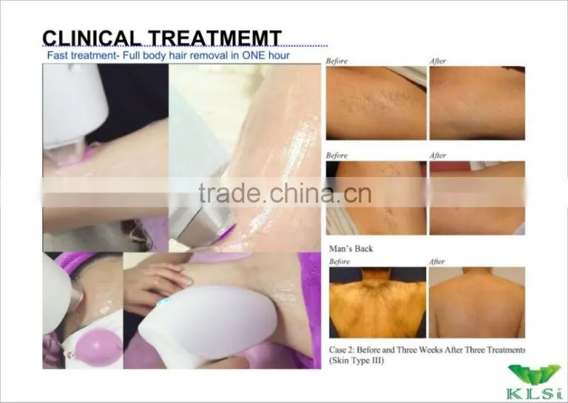 808nm professional laser hair removal equipment