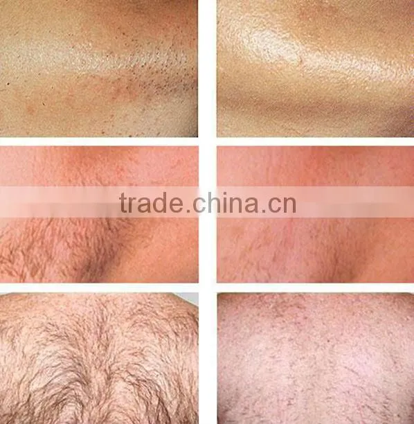Patent contact cooling tips ICE SHR technology hair removal aesthetic equipment ICE 1