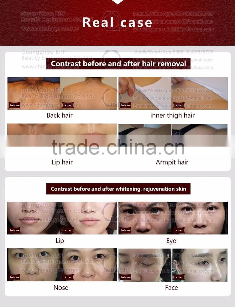 Portable and comfortable mini 808 diode laser permanent hair removal