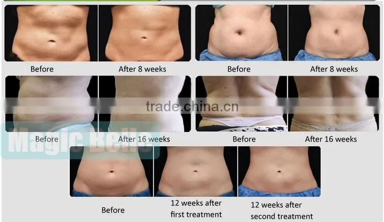 New Machine!! Cavitation RF/Fat Freezing Machine Cryolipolysis Machine for Home Use
