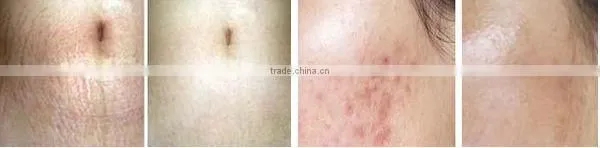 205 the most professional +powerful 540 needle facial beauty roller