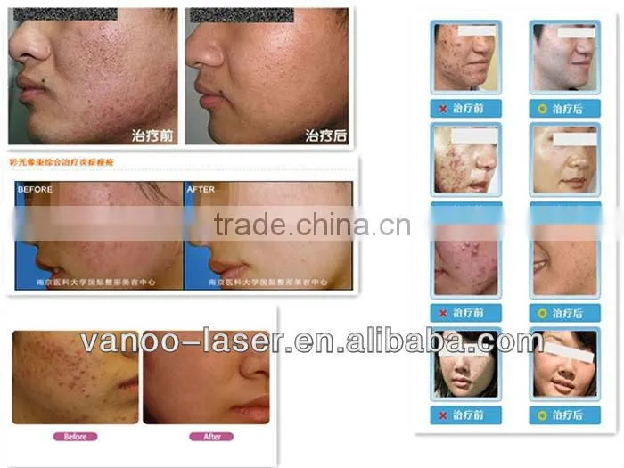 Clinic use skin whitening solution red led light machine