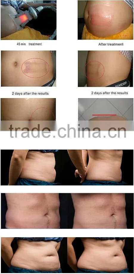 cryolipolysis + criolipolisis machine + portable cryolipolysis machine for home use CRYO6S