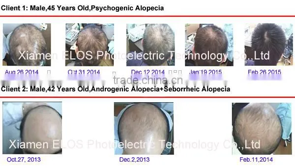 New arrival hair growth for preventing hair loss