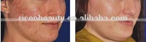 Power Line and Changeable Heads LED Light Microneedle Derma Rolling