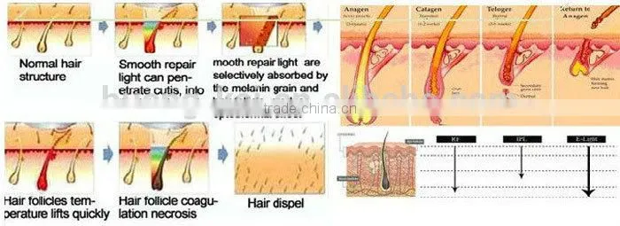 Powerful e-light ipl shr pigmenation wrinkle Hair removal machine