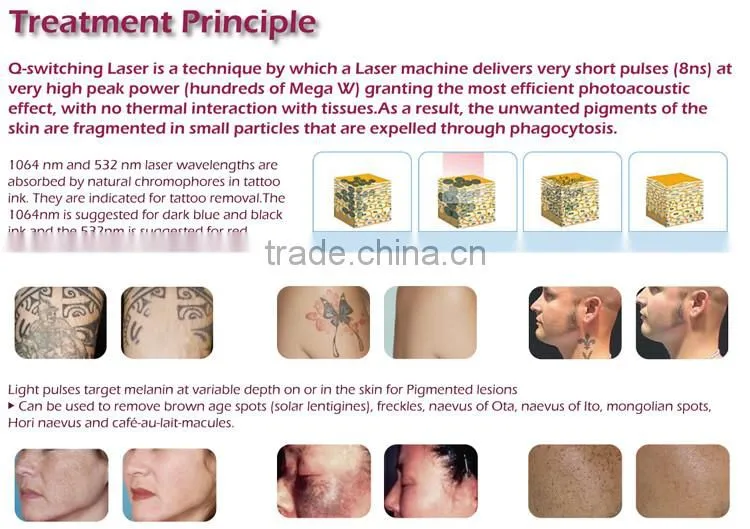 Korea original logo customized supported loading interface 7 joints arm q laser tattoo removal machine