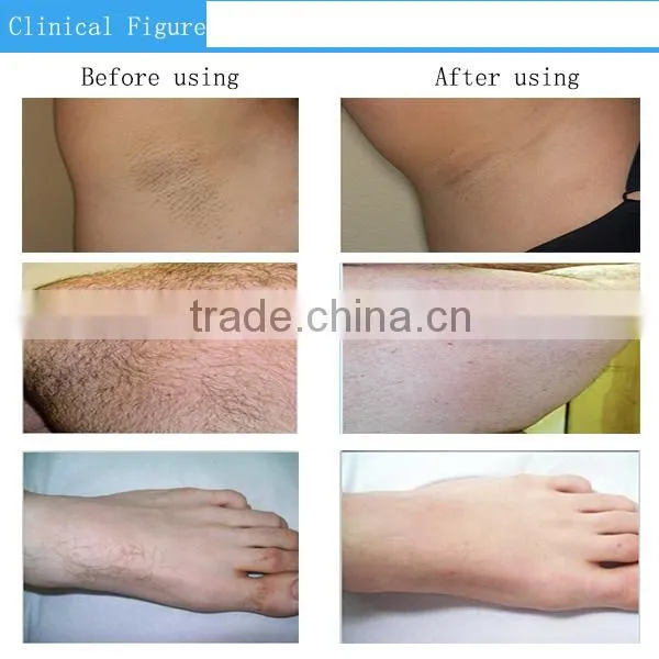 Wholesale High Quality ipl portable