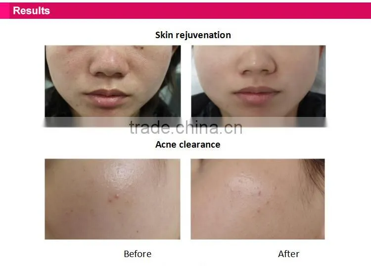 2015 Professional IPL Technology hair removal equipment for home use