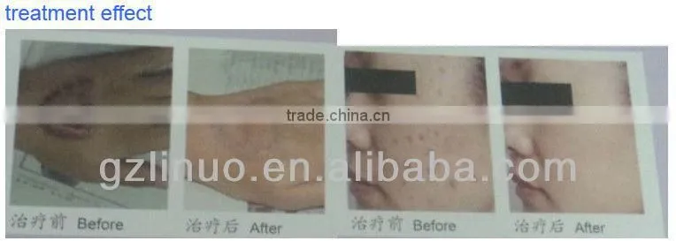 2013-2017 popular RF laser vacuum latest technology (The newwest technology !!!!!!!!!)