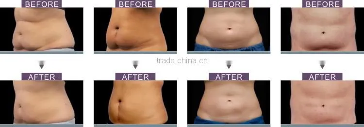 Body shaping machine/ cool slimming machine/ cool tech fat freezing machine