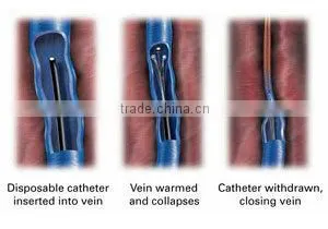 portable spider vein removal machine