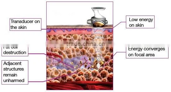 Hot in USA 2015 new designed vertical hifu body slimming machine