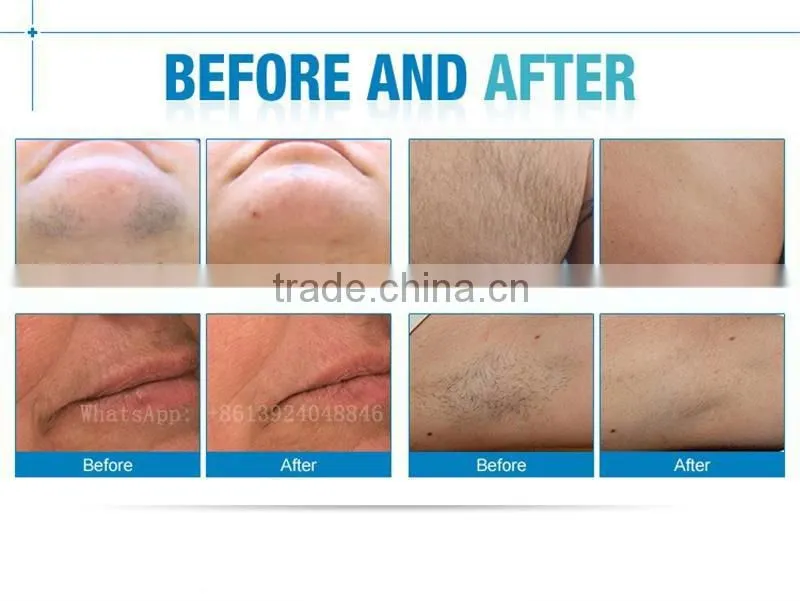 cheap portable 808nm laser diode/808nm/laser hair removal machine