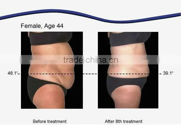Lipo Laser Diode Laser Slimming Machine For Fat Reduction Weight Loss