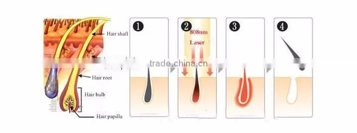Hot Sale Large Spot Size Laser 808 Hair Removal Laser Epilation Home