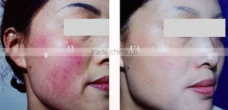Companies Looking for Distributors Agents for Our Machine Turkish Language Medical Equipment for Spider Vein Removal