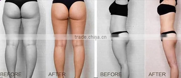 Micro machine liposonix hifu fat reduction 2016 new lipo slimming machine in alibaba