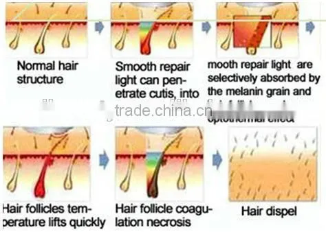shr ipl hair removal machine/super hair removal/ipl shr +elight