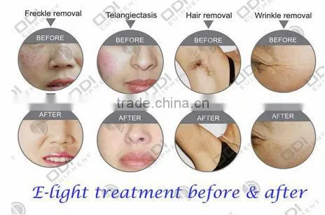 E-light Portable IPL Machine For Skin Whitening OD- E60 With CE