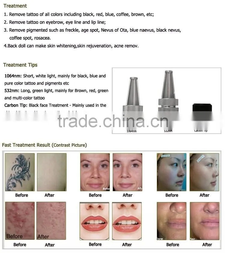 fast delivery q switched nd yag laser machine