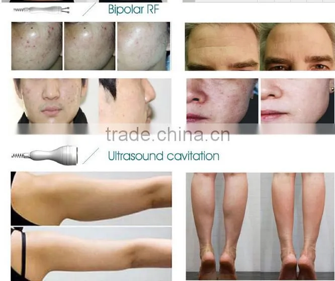 high intensity focused ultrasound HIFU for body slimming machines hifu system / portable hifu machine / ultra age hifu ultraform