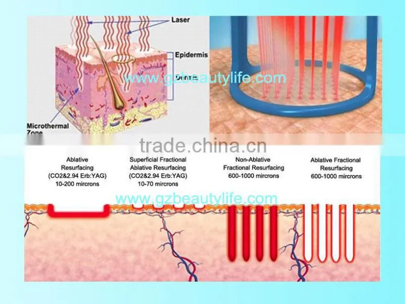 2016 Laser RF Fractional CO2 Laser Vagina Tightening/CO2 Laser Scar Removal Machine/RF