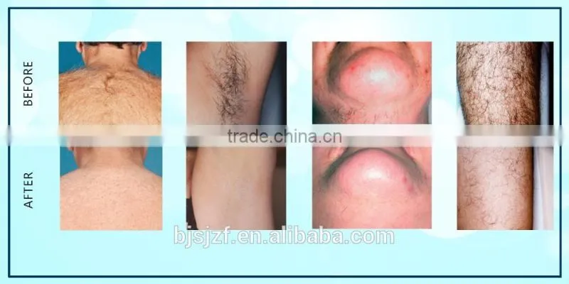 Anybeauty Portable 808t-2 808nm didoe laser hair removal machine