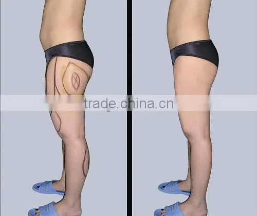 5 Treatment Head Cavitation Tripolar RF Vacuum Body Slimming Machine F019