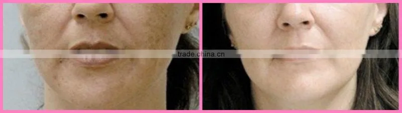 e light facial beauty salon equipment