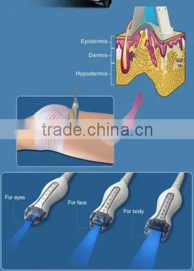 rf radio frequency bipolar radio frequency(wrinkle removal quickly!!!!)