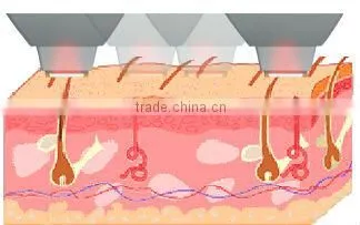 RF skin care equipment portable beauty salon equipment HS 530 by shanghai med apolo medical technology