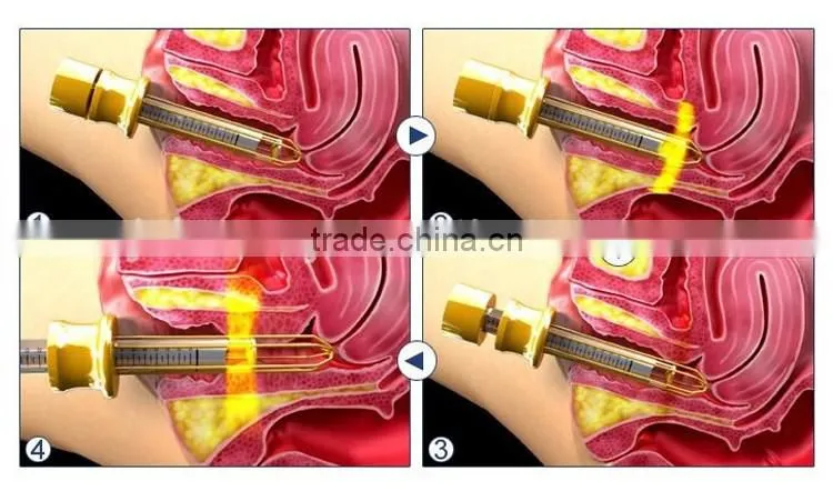 2016 Good effect 25mm focal length hifu vaginal tightening machine with CE certificate