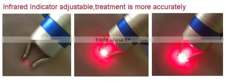 Diode laser 980nm vascular machine for spider vein removal