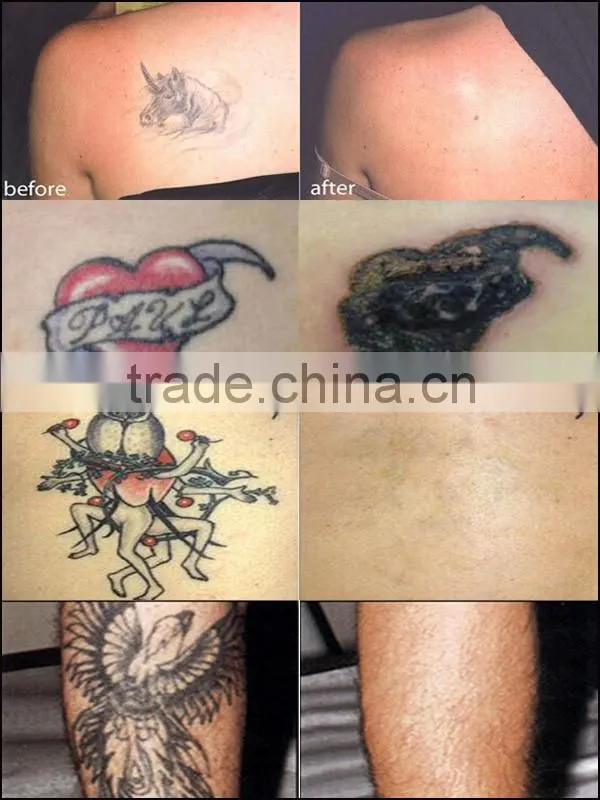 High cost-perormance easy work long time continues CE approved Q Switched Nd yag laser professional tattoo removal machines