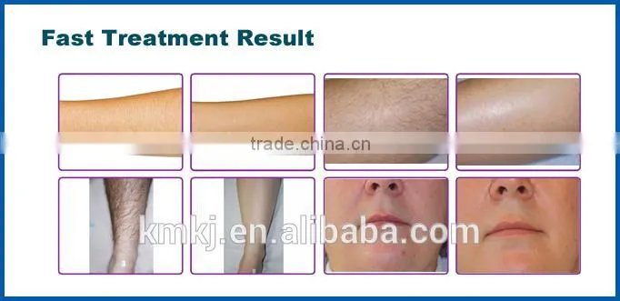 2016 Newest 808 laser diode hair removal portable