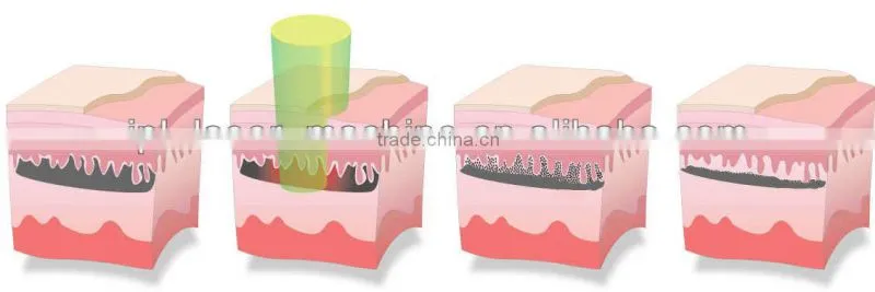 2014 factory price hot seller nd yag laser / 1064nm & 532nm / q-switched nd yag laser beauty machine