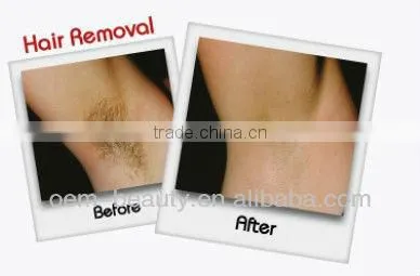 NEW RF skin rejuvenation ND YAG laser tattoo removal machine ipl elight for loss weight
