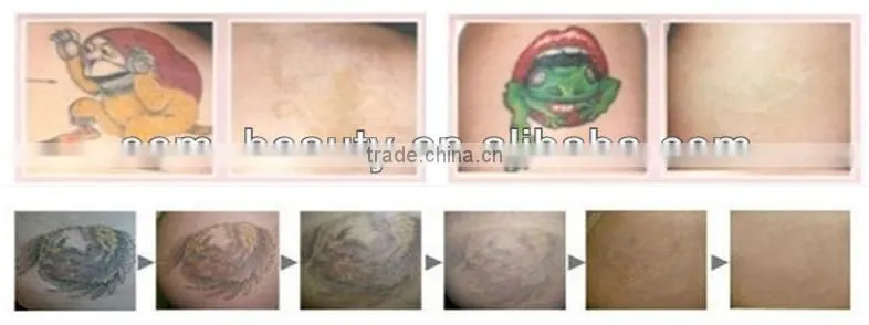 skin rejuvenation and permanent /painless tattoo removal machine