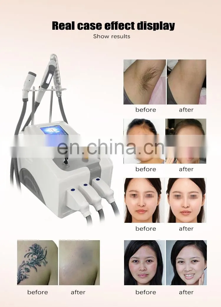 Portable type home use 3 in 1 pico laser ipl hair removal beauty device for tattoo removal skin rejuvenation