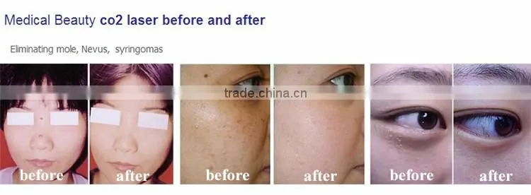 Professional Medical CO2 Laser for Dermatology