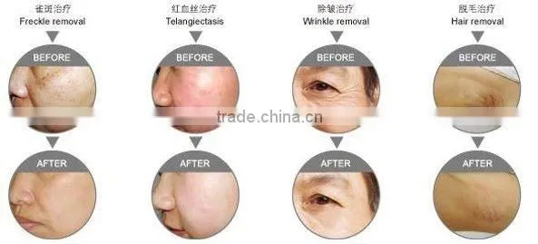 Medical hair removal aesthetic equipment