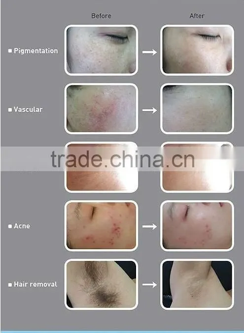Hot ! ipl rf hair removal system at home