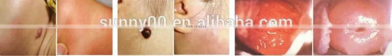 40W Co2 laser Medical co2 laser Sunny Laser