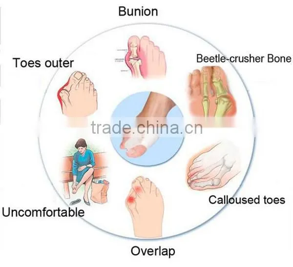Hebei Aofeite High quality Bunion Corrector 100% Medical Silicone Hallux Valgus Pro for Footcare