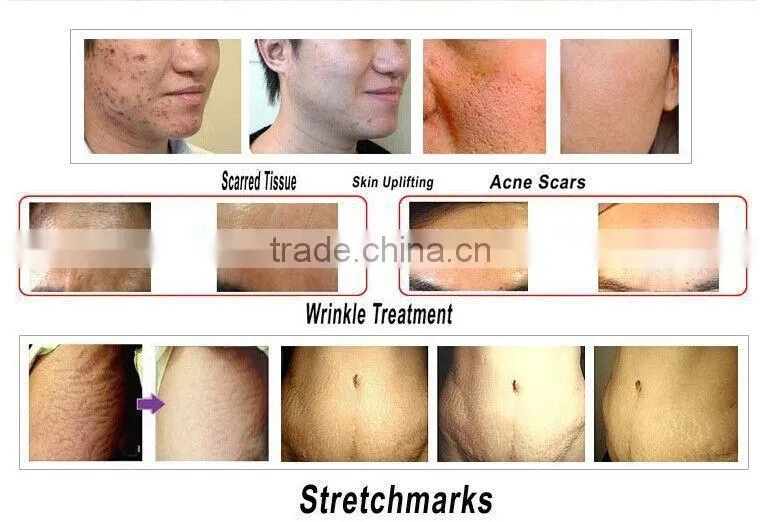 beauty facial roller microneedle therapy 180 derma roller