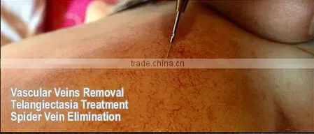 2014 New design RBS high frequency vascular removal machine